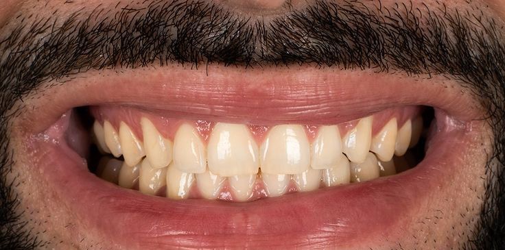 Gülüş Tasarımı Öncesi