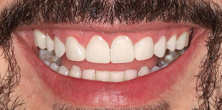 Aralıklı Diş Tedavisi Sonrası