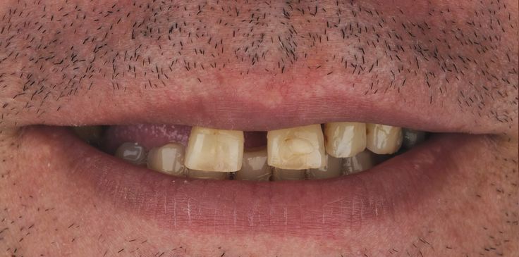 Tam Ağız Restorasyonu Öncesi