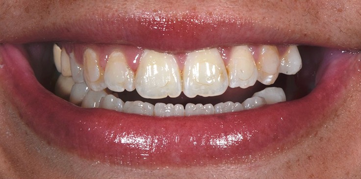 Laminate Veneer Öncesi